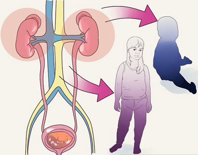 Nephrotic syndrome in childhood