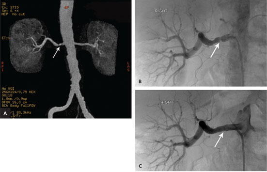 Non-invasive imaging cannot replace formal angiography in the diagnosis of renovascular hypertension